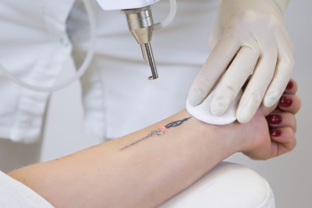 Tattoo Removal in North Vancouver