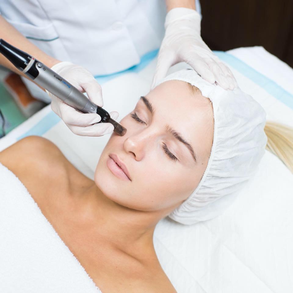 Microneedling Facial Treatment in North Vancouver