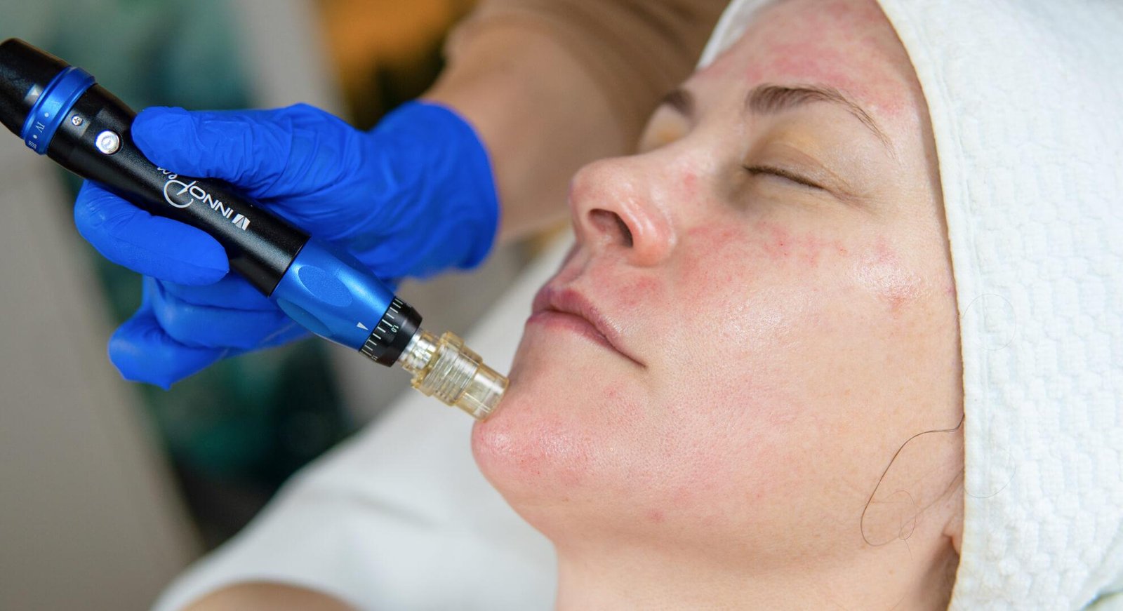 micro-needling